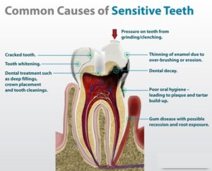 The Common Causes Of Teeth Sensitivity. - Platinum Dental Surgery