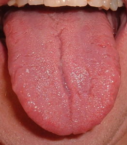 clean-tongue
