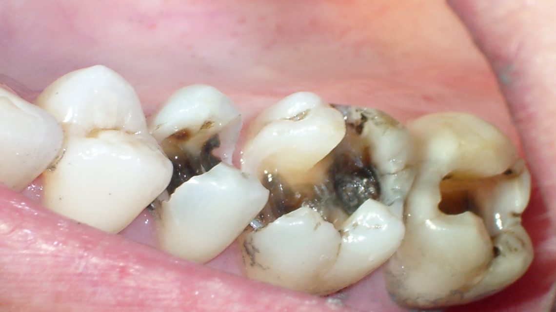 dental-cavity