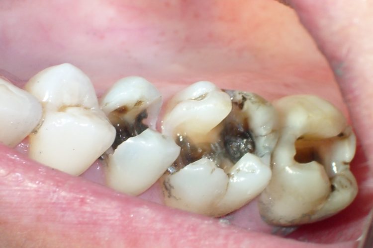 dental-cavity