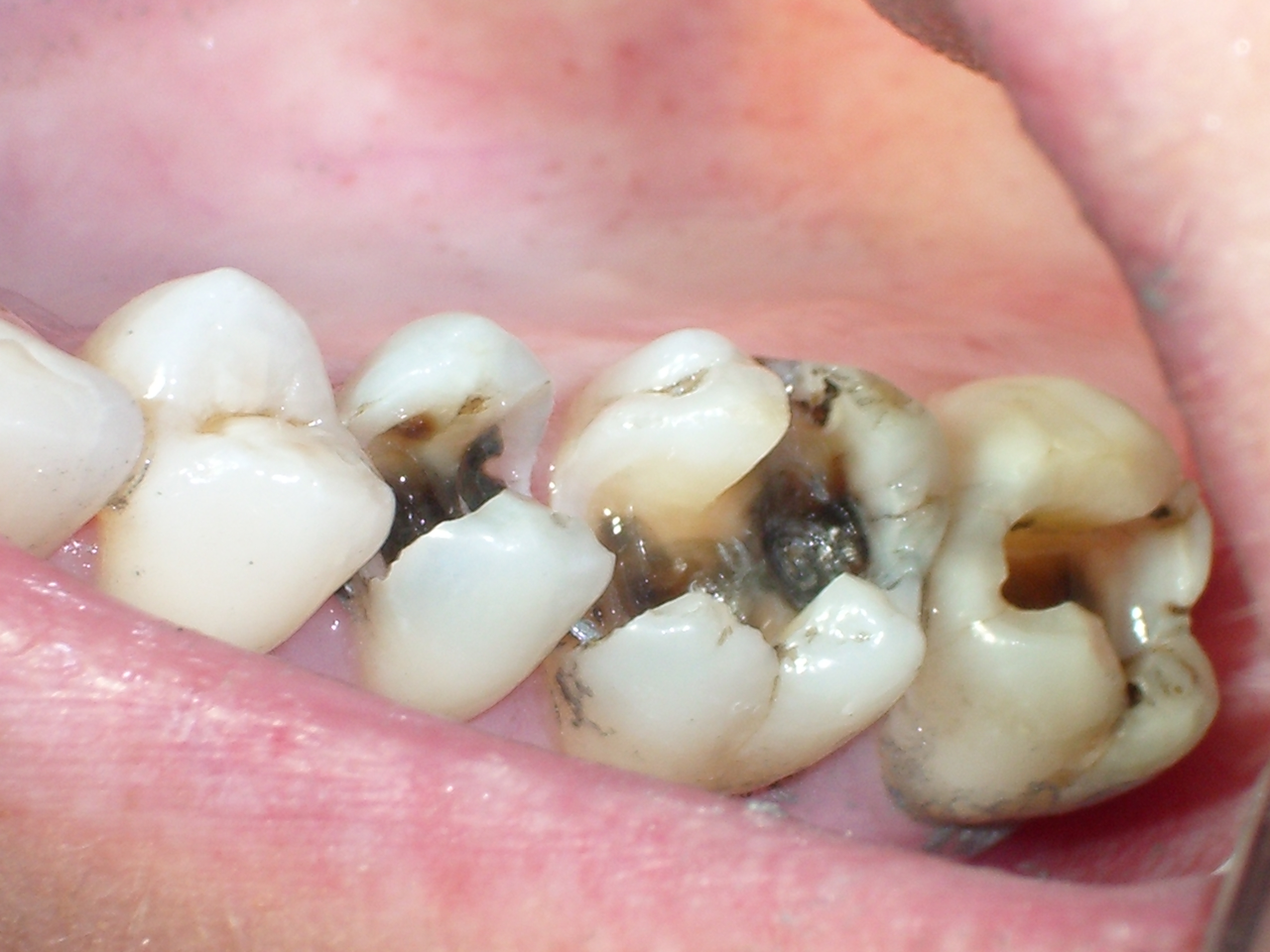 dental-cavity