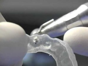 dental-implant-surgery-implant-placement