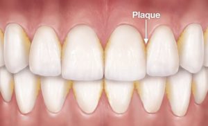 plaque-formation