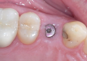 post-dental-implant-surgery-