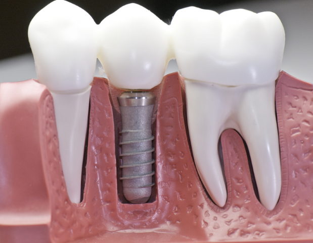 successful-dental-implant-surgery