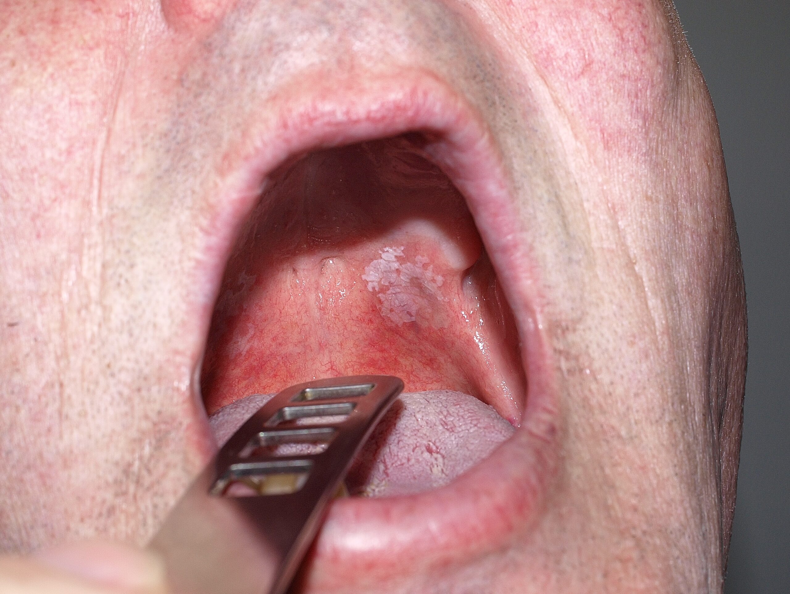 How To Treat Burns On Your Palate