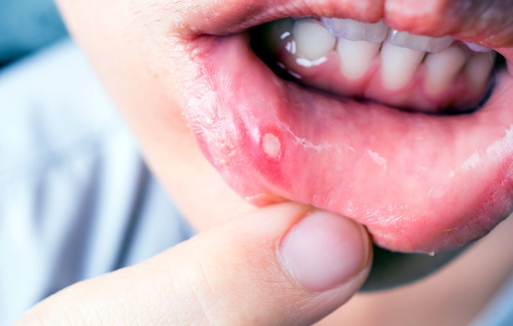 what-is-the-difference-between-cold-sores-and-mouth-ulcers-news