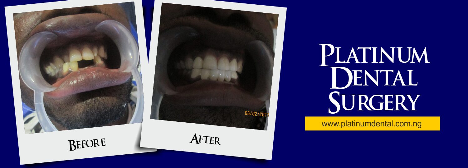 Smile Gallery | Real Patient Transformations 11 Smile Gallery Platinum Dental surgery 2