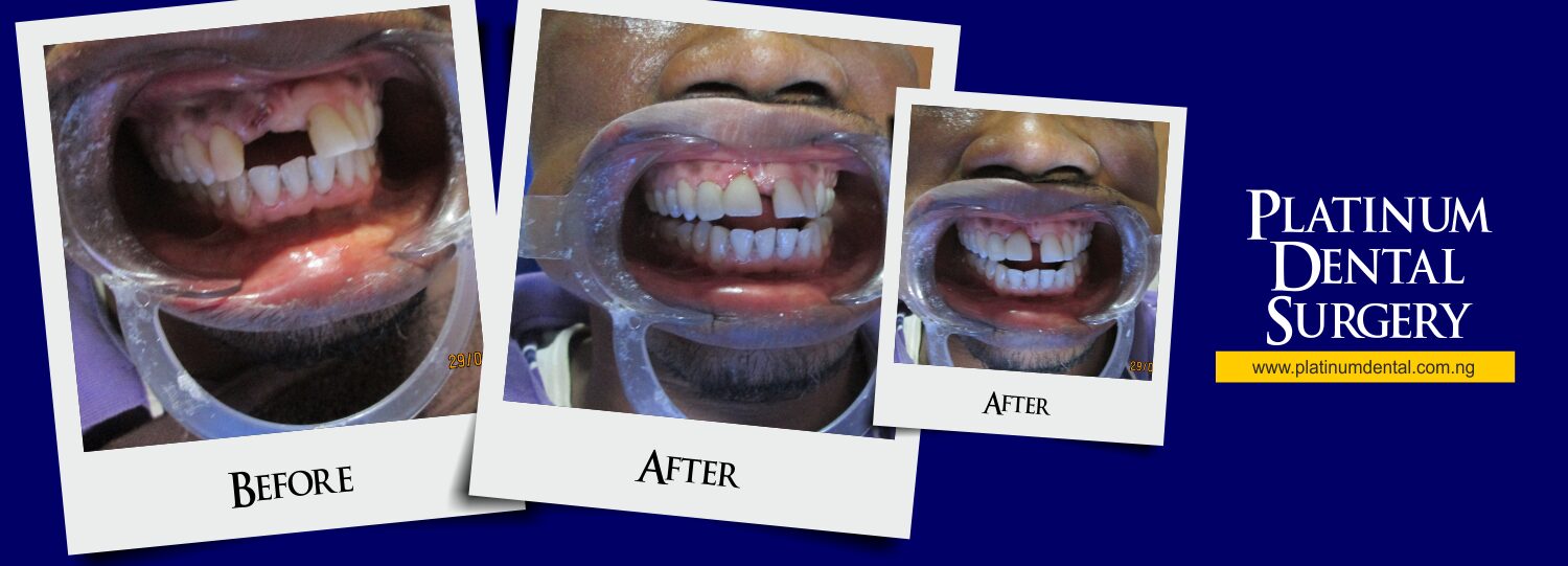 Smile Gallery | Real Patient Transformations 10 Smile Gallery Platinum Dental surgery 22