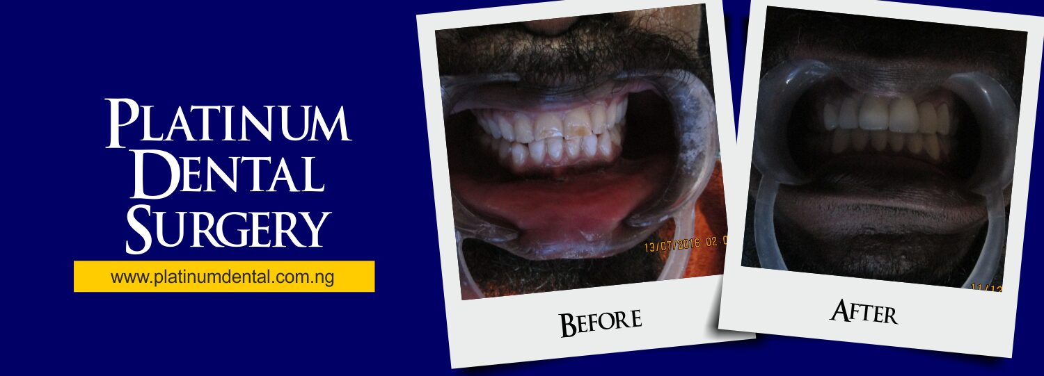 Smile Gallery | Real Patient Transformations 12 Smile Gallery Platinum Dental surgery 24