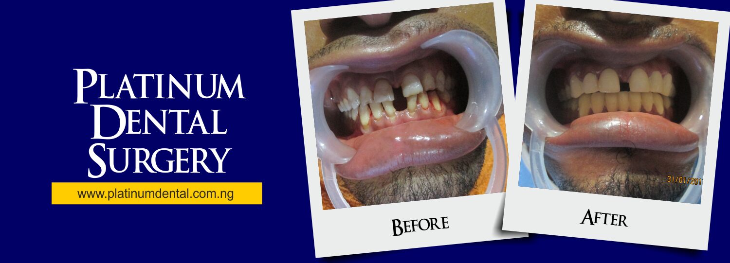 Smile Gallery | Real Patient Transformations 13 Smile Gallery Platinum Dental surgery 25
